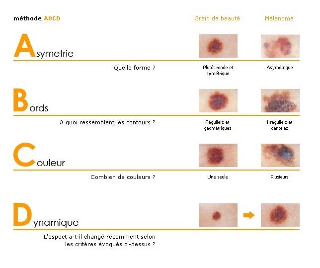 Surveiller ses grains de beauté - Guide Astuces