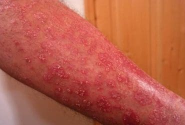 Traitements et remèdes naturels contre le psoriasis