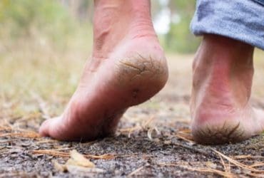 Pieds secs : 6 remèdes naturels pour retrouver des pieds tout doux